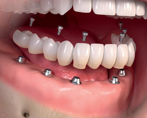 Prothèse clipsée : la solution pour remplacer partiellement ou complètement les dents manquantes