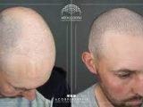 Micropigmentation du cuir chevelu